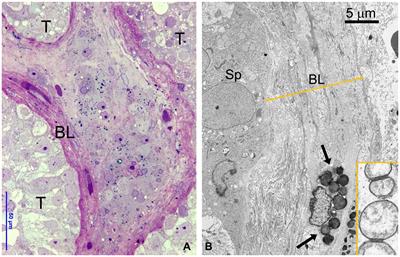 Infertility in Fabry’s Disease: role of hypoxia and inflammation in determining testicular damage